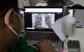 Dokter: Batuk lama hingga berat badan turun bisa jadi gejala awal TBC