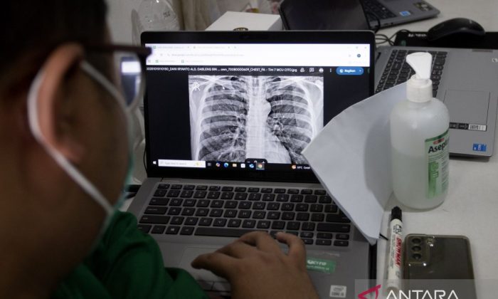Dokter: Batuk lama hingga berat badan turun bisa jadi gejala awal TBC