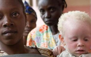 People With Albinism Face Discrimination, Danger